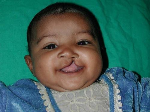 Free Cleft Surgery for 400 Poor Children in India