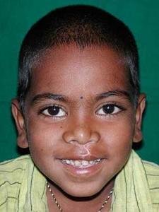 Free Cleft Surgery for 400 Poor Children in India