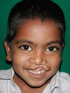 Free Cleft Surgery for 400 Poor Children in India