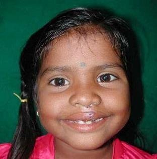 Free Cleft Surgery for 400 Poor Children in India