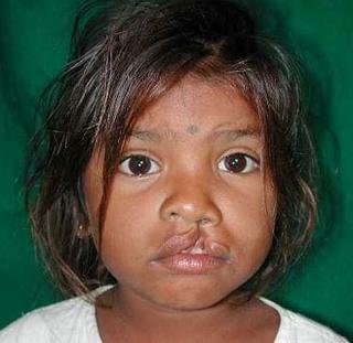 Free Cleft Surgery for 400 Poor Children in India
