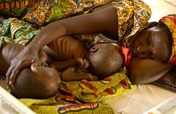 Treating Global Childhood Malnutrition