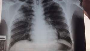 Tuberculosis ball in one of patient's lungs