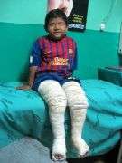 Jorgito during the casting phase of treatment.