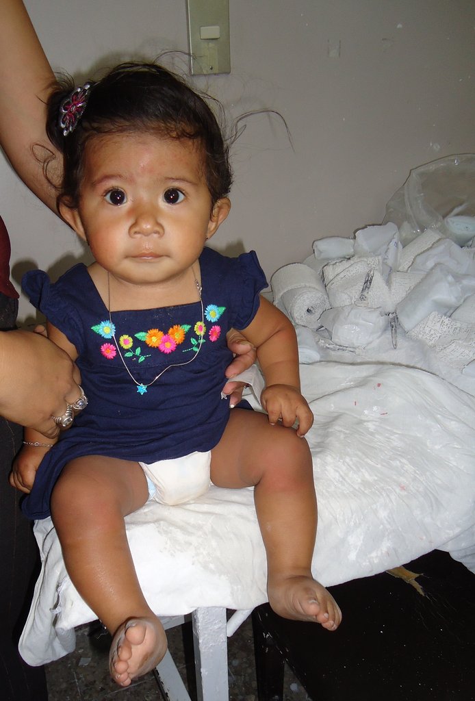 Support Clubfoot Treatment for 270 Children