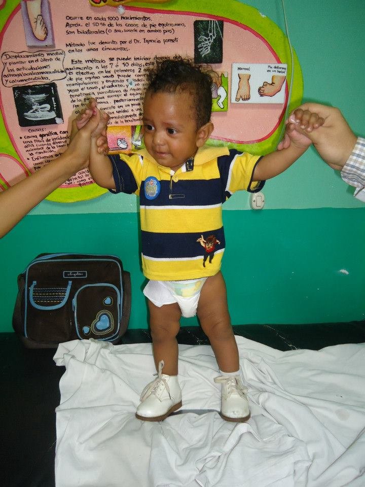 Support Clubfoot Treatment for 270 Children