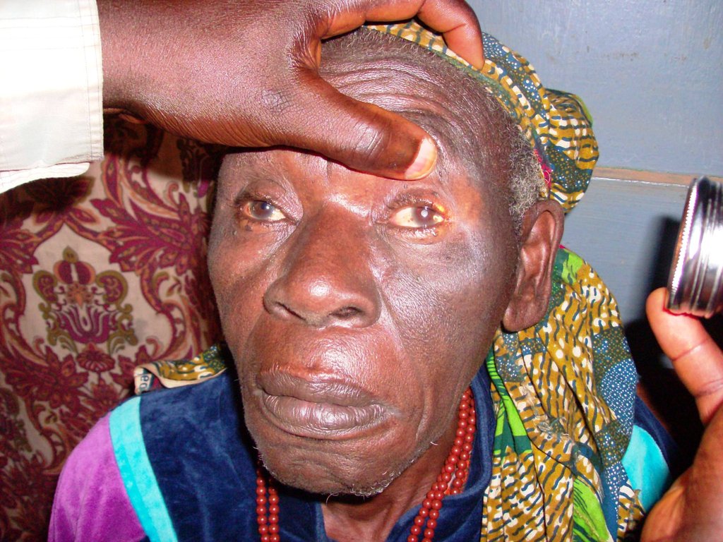 Prevent Blindness-Fund Cataract Surgeries Cameroon