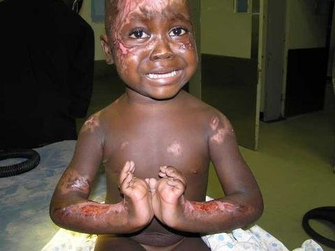 Free Surgery for 50 Burned Children in Zambia
