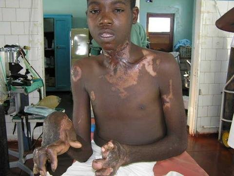 Free Surgery for 50 Burned Children in Zambia
