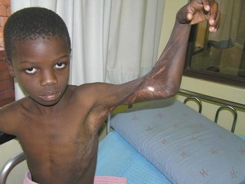 Free Surgery for 50 Burned Children in Zambia