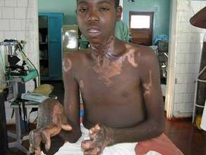 Burned youth in Zambia