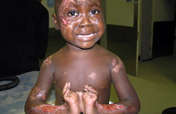 Free Surgery for 50 Burned Children in Zambia
