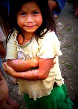 Child with skin rash from contamination