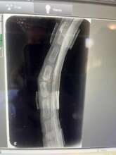 Xray after straightening procedure