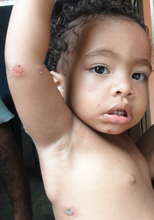 Child with skin infection