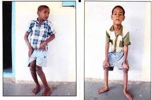 HANDICAPPED BOY