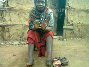 Touch the Lives of People with Leprosy in Somalia