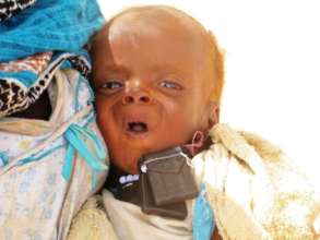 Darfur children are suffering serious malnutrition