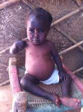 Little Suha who cannot walk due to malnutrition