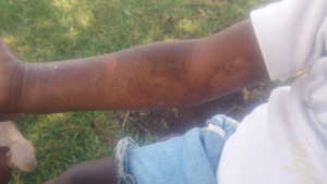 JS wounds are healing