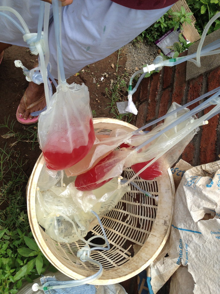 Dialysis drainage bags, filled with blood