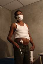 CKDu patient showing his PD catheter