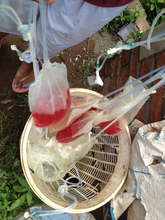 Dialysis drainage bags, filled with blood