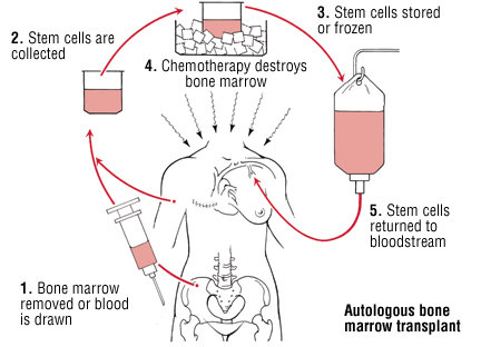 Treat blood cancer of thousands of people in Nepal