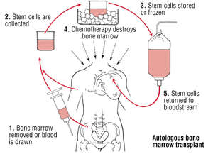 How transplants work
