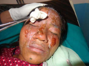 Manita Tamang, 15 yrs - Burns from scalding water