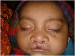 Mario after his first surgery