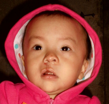 Dulce after her successful surgeries