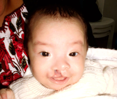 Dulce before her cleft lip and palate surgery