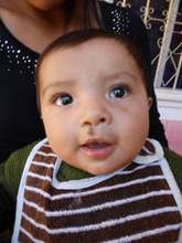 Gregorio after cleft lip surgery