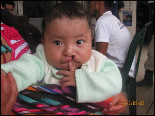 Surgery for Guatemalans with Cleft Lip and Palate