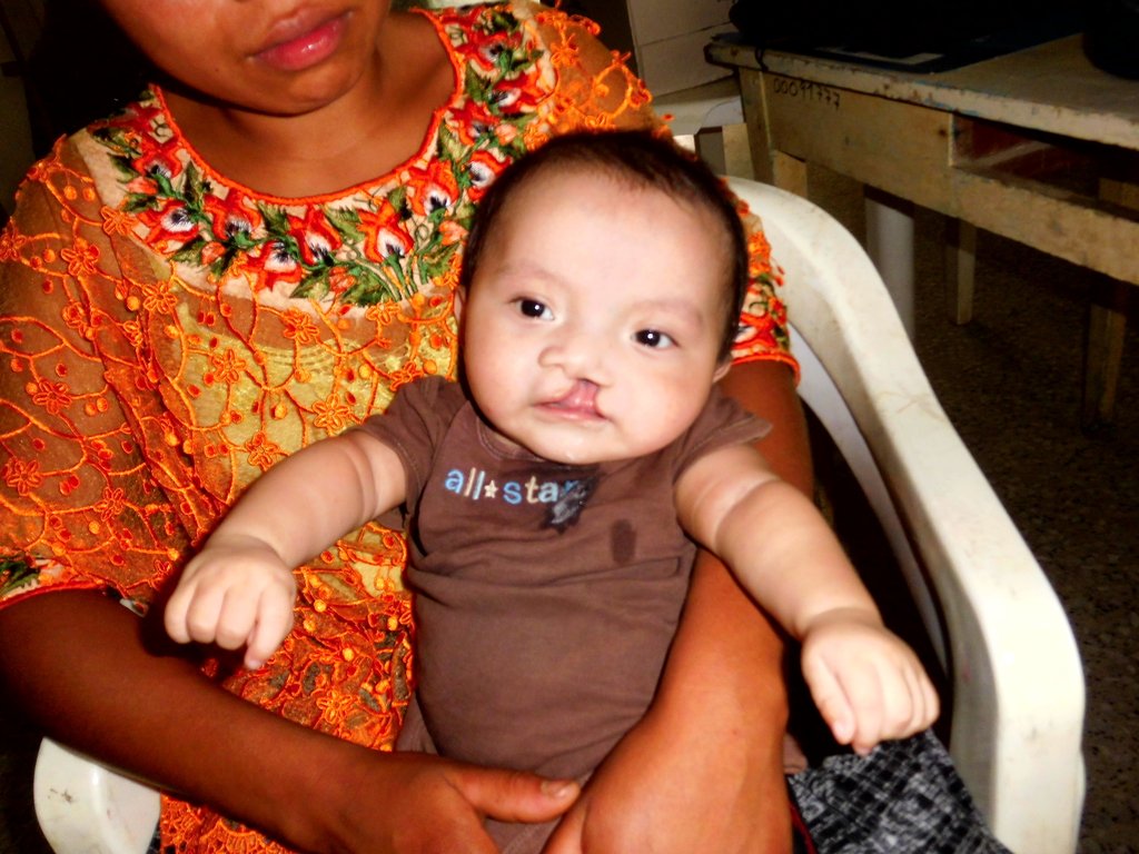 Surgery for Guatemalans with Cleft Lip and Palate