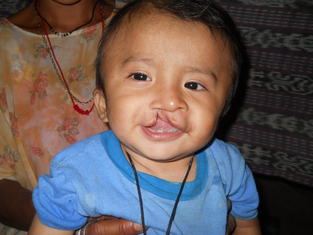 Surgery for Guatemalans with Cleft Lip and Palate