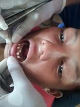 Double Row Teeth