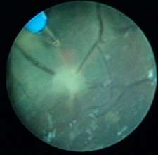 Laser coagulation