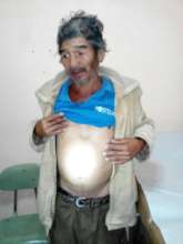 abdominal distention