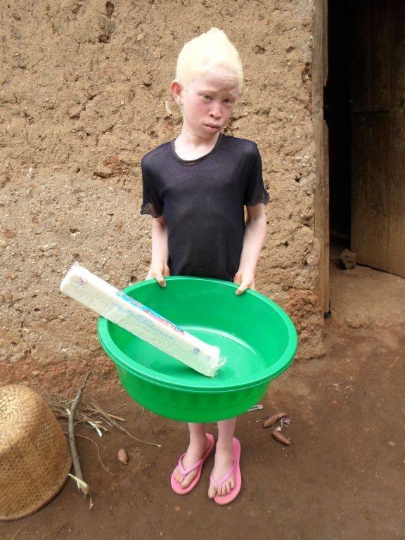 Help 10 Albino Children Saved from Sacrifice