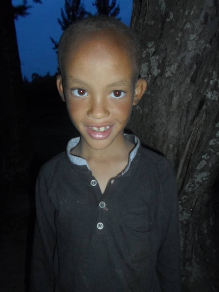 Help 10 Albino Children Saved from Sacrifice