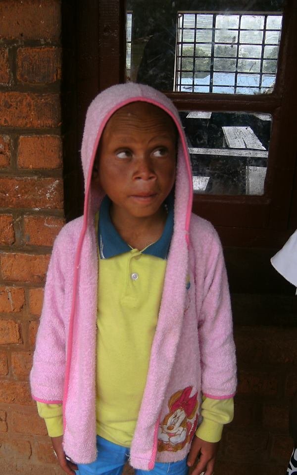 Help 10 Albino Children Saved from Sacrifice