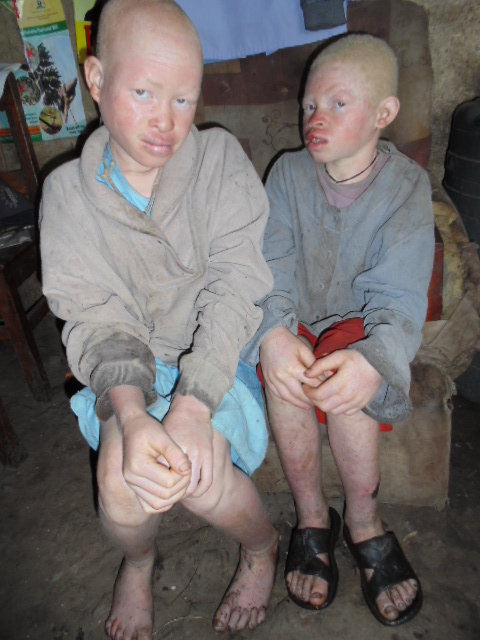 Help 10 Albino Children Saved from Sacrifice