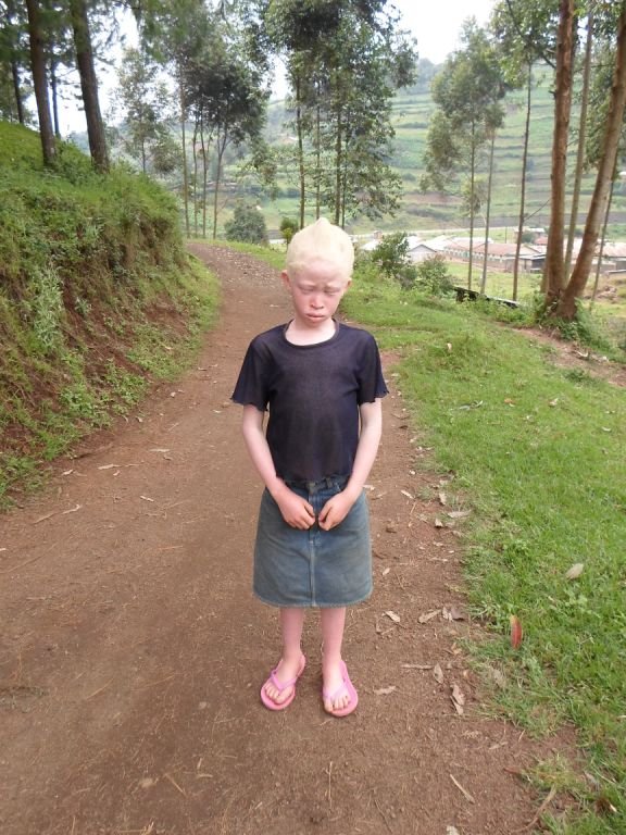 Help 10 Albino Children Saved from Sacrifice