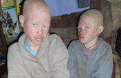 Help 10 Albino Children Saved from Sacrifice