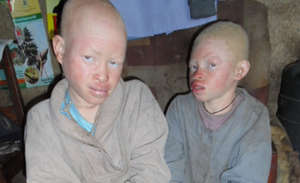 Help 10 Albino Children Saved from Sacrifice