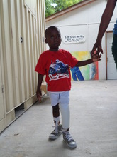Raphael with his new Prosthesis