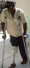 Above the Knee Amputee WRF Patient