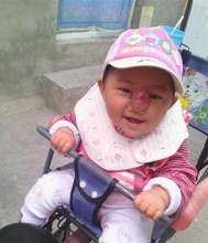 Lovely Ruotong has a "big" nose because of a tumor